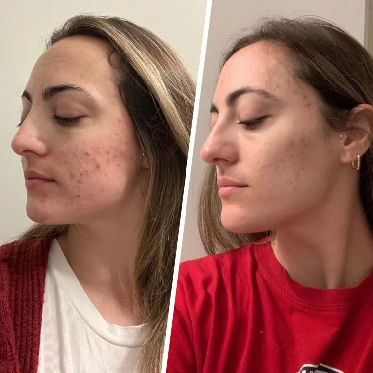 Avant et après l'utilisation des produits Innisfree à la Vitamine C sur des taches brunes