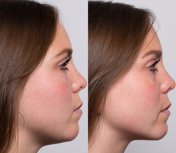 Gua sha: the before/after results of this ancestral technique –  Monjoliguasha